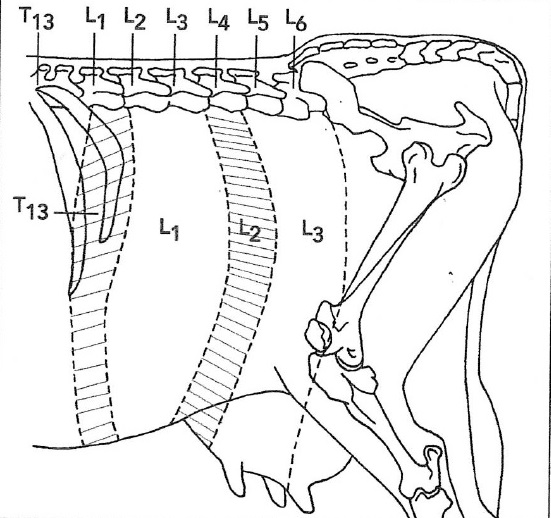 Figure 17 : Régions du flanc anesthésiées après une anesthésie paravertébrale proximale ou distale – Référence bibliographique n°4, page 11 Figure 17 Régions du flanc anesthésiées après une anesthésie paravertébrale proximale ou distale