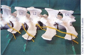Figure 19 : Modélisation de la position de l’aiguille lors d’une anesthésie paravertébrale distale – D’après Guattéo et Holopherne 2006, Référence bibliographique n°25, page 37